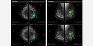 루닛 미국에 3D 유방암 검진 '루닛 인사이트 DBT' 공급, 