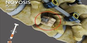 대웅 시지바이오 '노보시스 퍼티', 미국 FDA 확증임상 승인 획득 